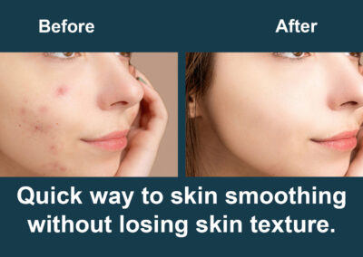Smoothing Skin Using Photoshop Patch Tool and SkinFiner Plugins